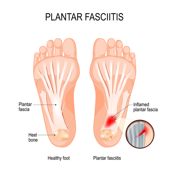 ultrasound and laser therapy for plantar fasciitis